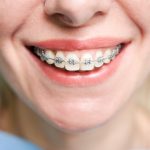 Smiling young woman with braces on teeth.